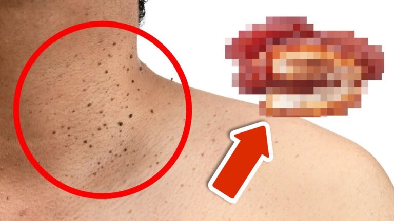 7 überraschende Lebensmittel, die Hautanhängsel verursachen könnten! Entdecke die Wahrheit!