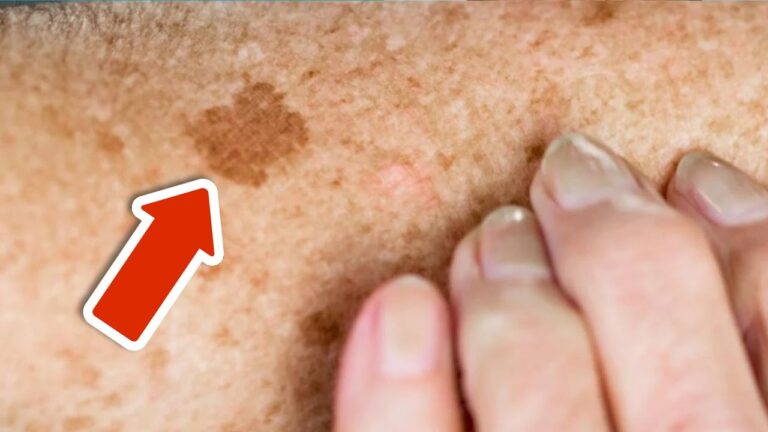 Dieses Vitamin entfernt 7 Altersflecken für immer – So funktioniert’s!