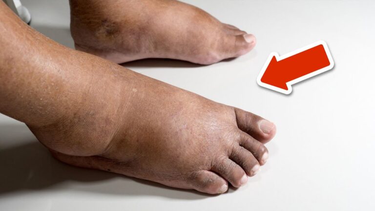 5 unwiderstehliche Vorteile von Vitamin gegen Schwellungen in Füßen und Beinen