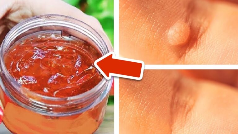 Reibe 1 erstaunliches Hausmittel auf deine Warze und entferne den Virus dauerhaft!