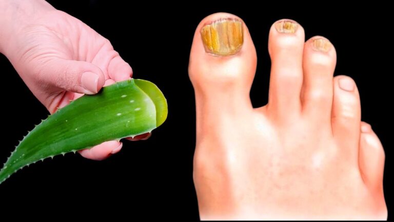 Besiege Nagelpilz: 5 Vorteile von Aloe für gesunde Nägel entdecken!