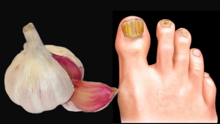 Entferne Nagelpilz in 7 Tagen: Das 100% natürliche Heilmittel entdecken!